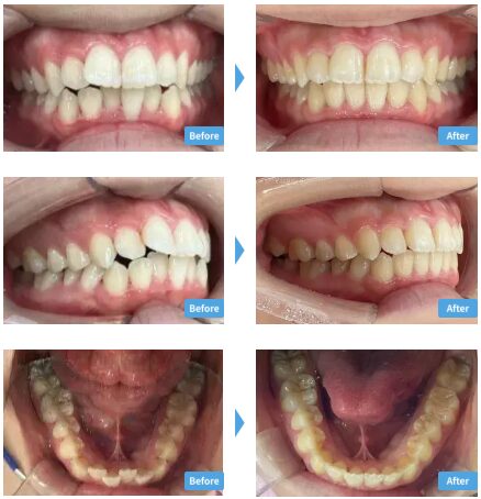 スマイルモア矯正 全体 矯正症例